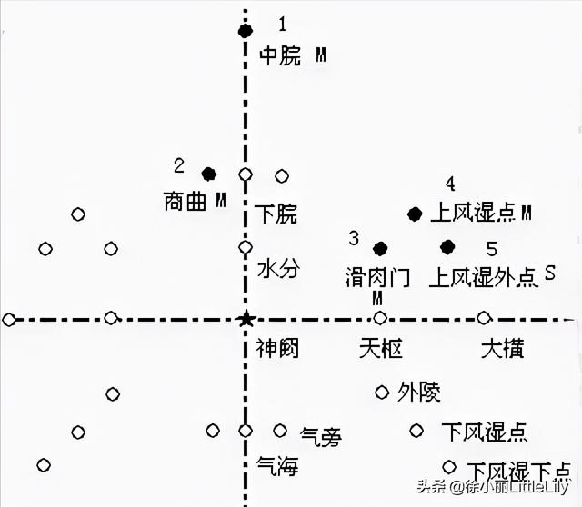 八字疗法专用针具