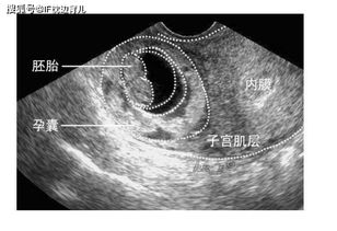 风水怀孕为什么宝宝没有胎心