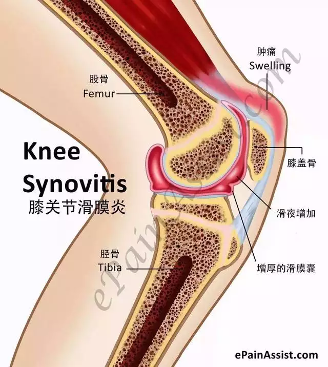 3、15天逼走滑滑膜炎的方法:轻度滑膜炎的根治办法