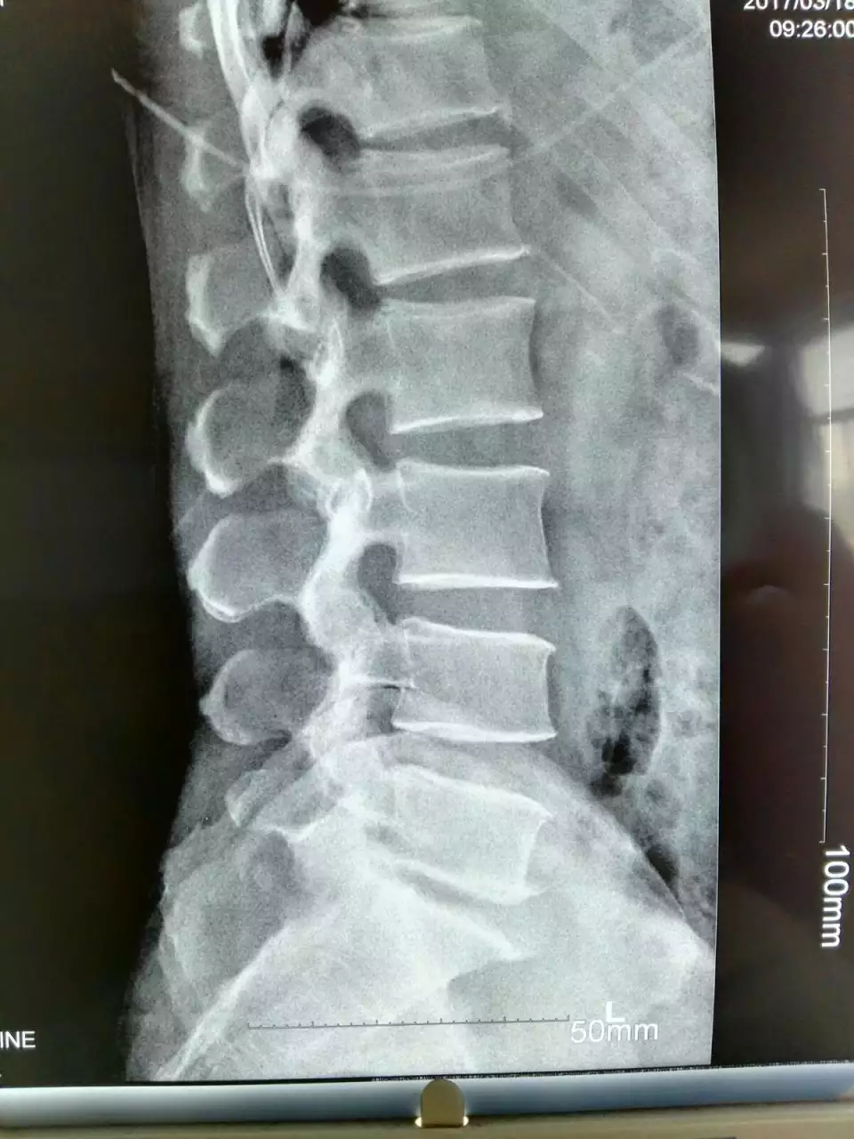 1、腰5骶1突出正确睡姿图片:，正确的睡觉姿势是怎么样的呢？