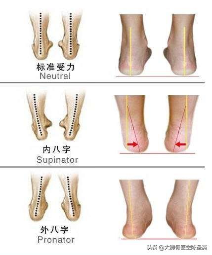 孩子走路内八字如何纠正