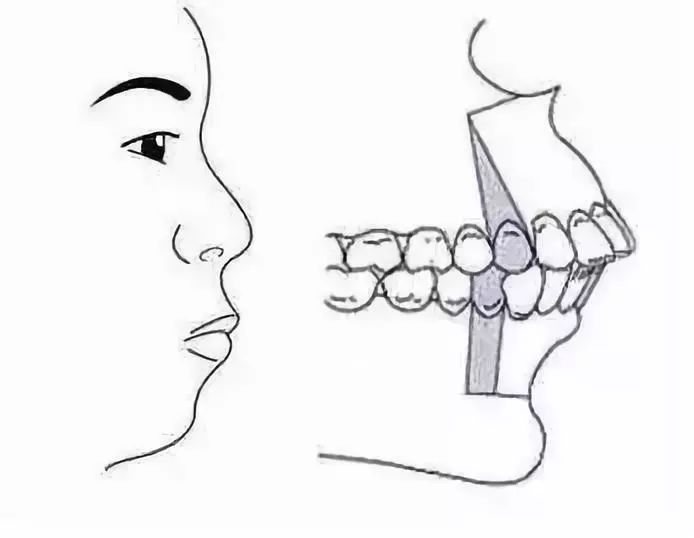 地包天面相如何矫正(下巴地包天的女人命运)