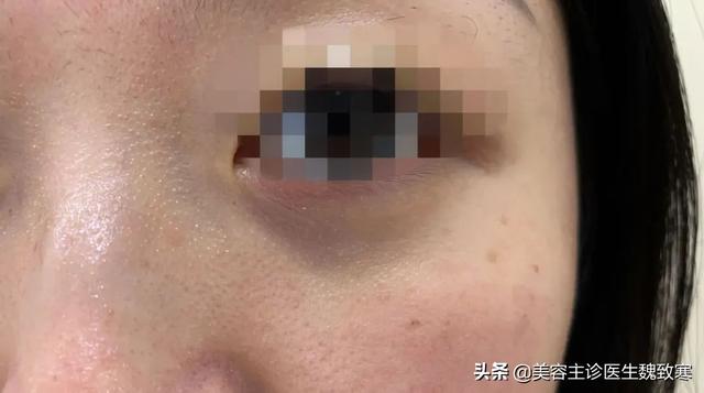 黑眼圈是渣男？黑眼圈很重是什么原因？