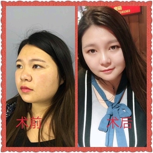 翘鼻子面相_女人10处有痣是富贵痣