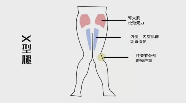 腿型内八字怎么改_内八字腿型如何矫正