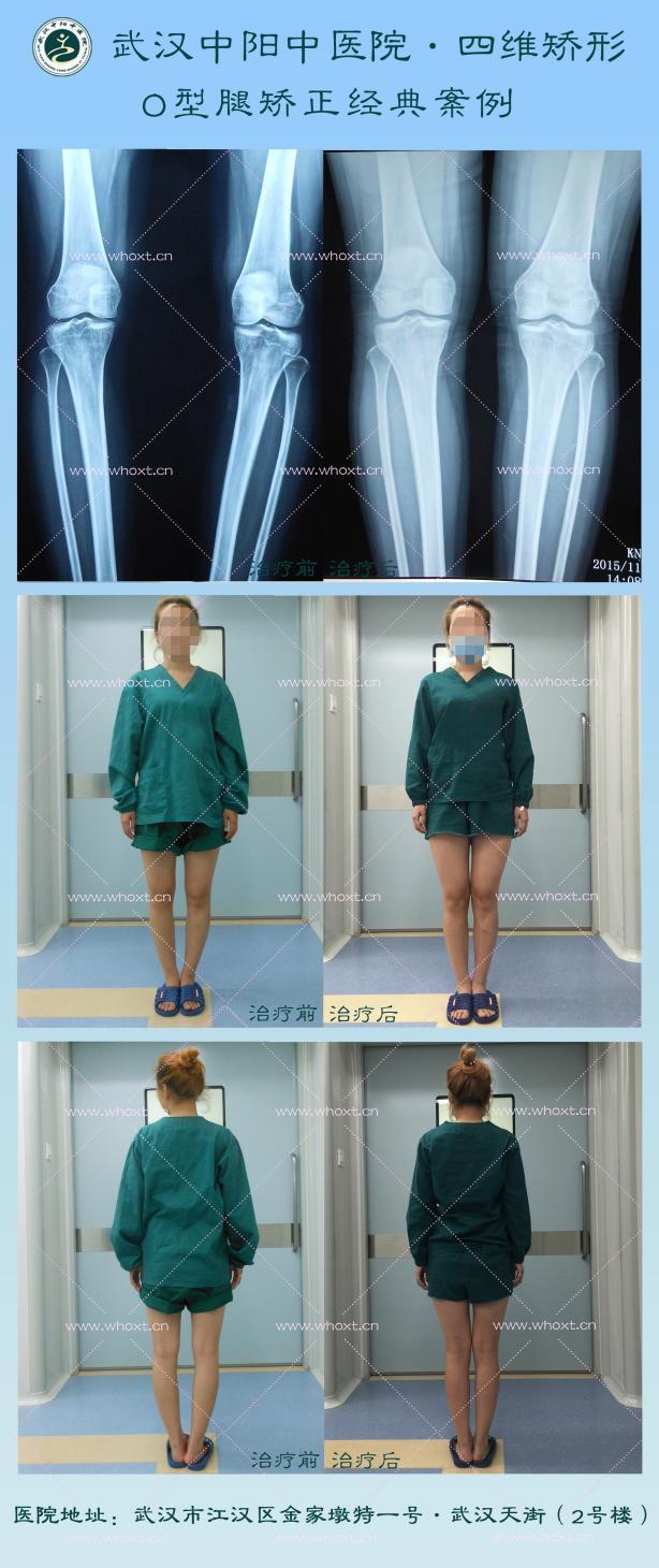 o形腿外八字矫正_o型腿外八字脚手术多少钱