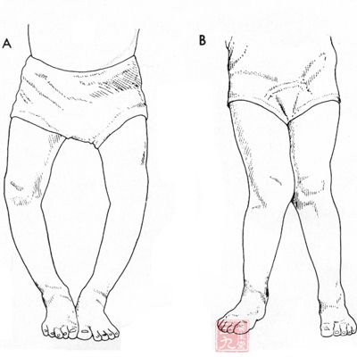 腿内八字，30岁外八字腿怎么矫正
