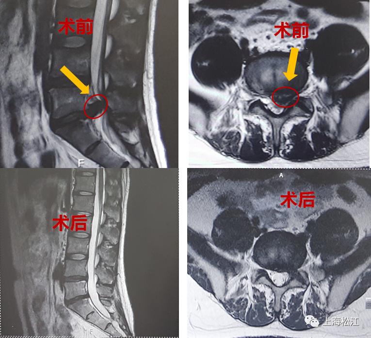 腰椎间盘易筋术，椎间盘手术后很后悔