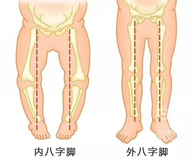 如何纠正内八字走路图