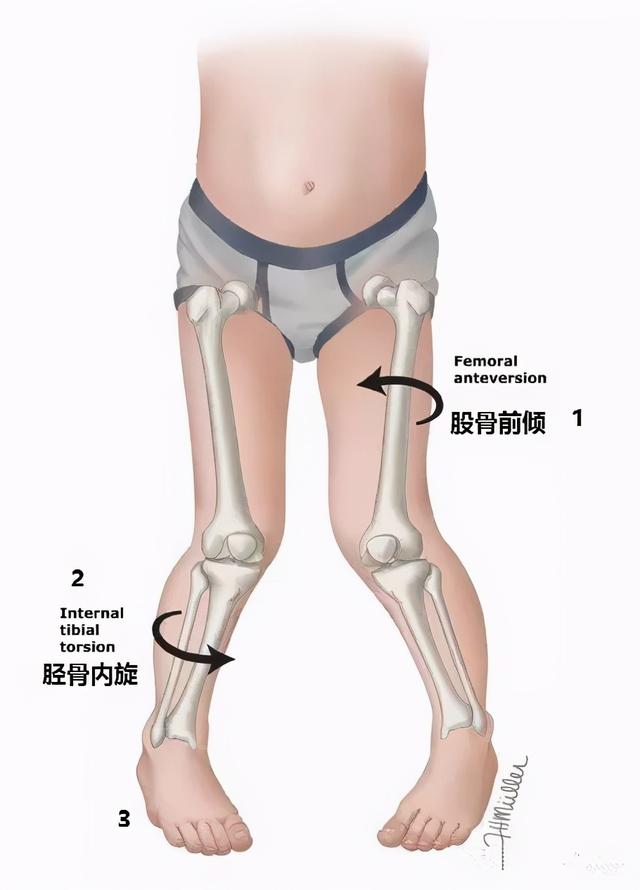 儿童点内八字怎么如何矫正