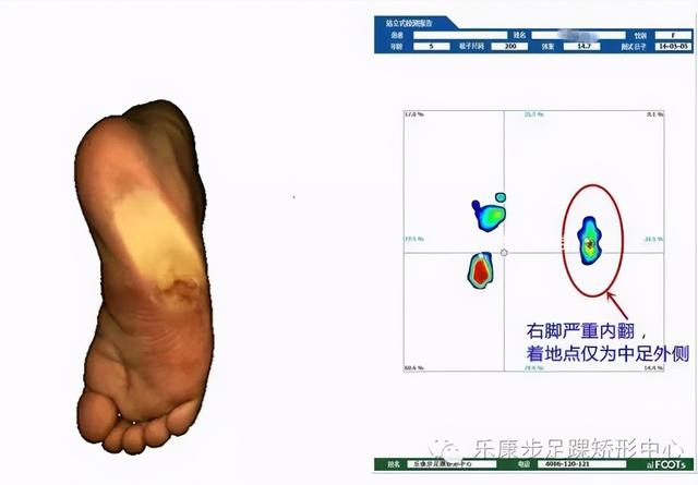 儿童点内八字怎么如何矫正