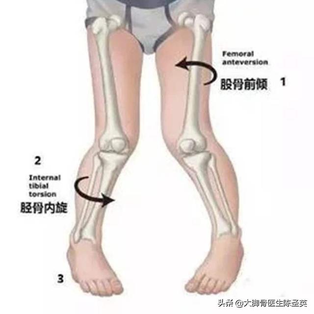 孩子走路点内八字如何矫正