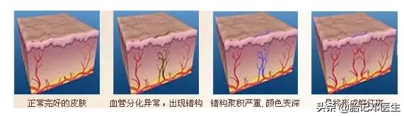 后脑勺有红色的一片胎记命运如何