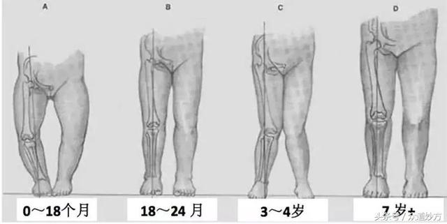 内八字脚睡觉如何捆矫正