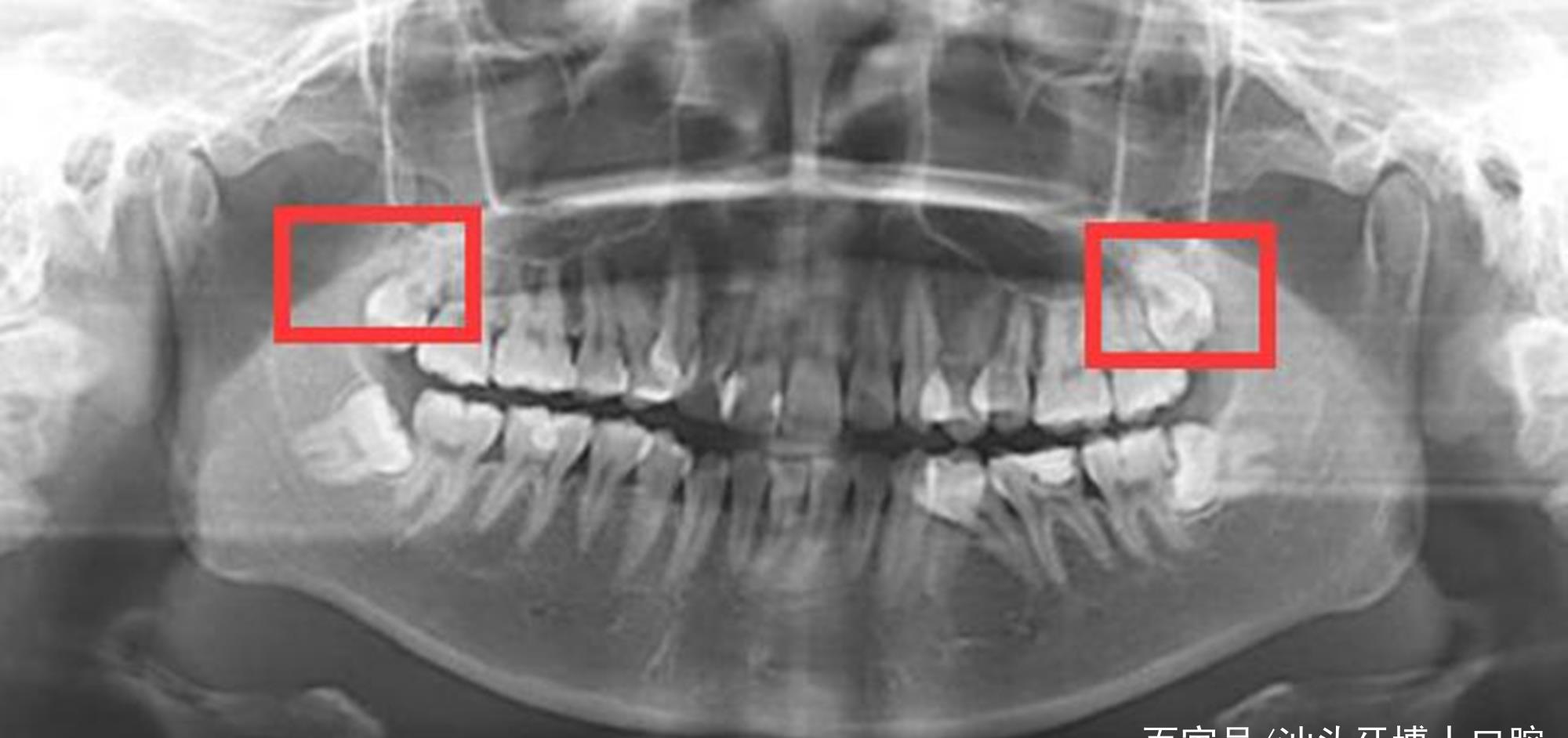 关于四颗智齿的人命运如何的信息